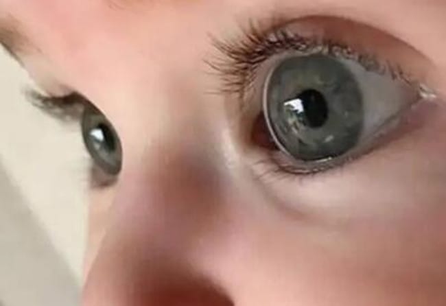 新生儿眼睛一只大一只小是怎么回事