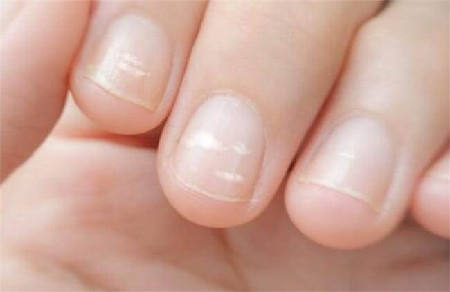 宝宝指甲上有白斑是什么原因