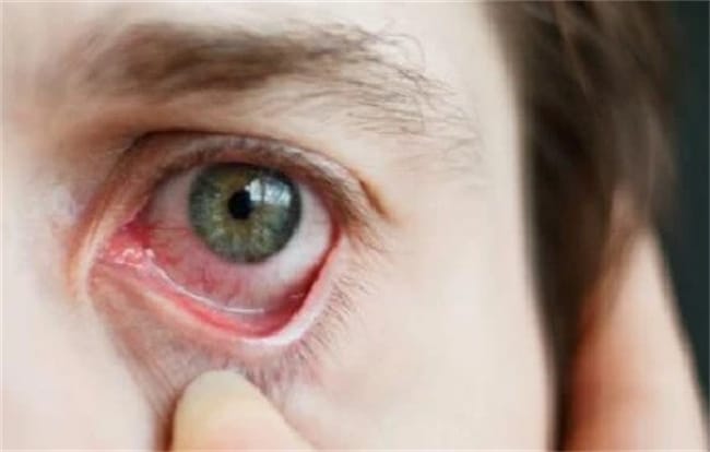 感染新冠病毒后眼睛疼痛如何缓解
