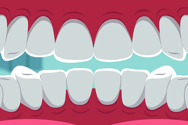 牙套的作用是什么 戴牙套注意事项