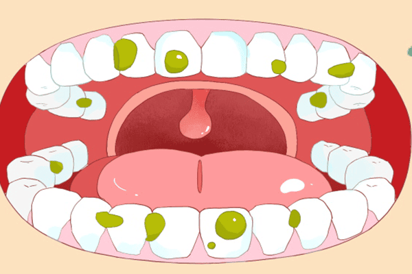 口角炎吃什么好 口角炎饮食要注意什么