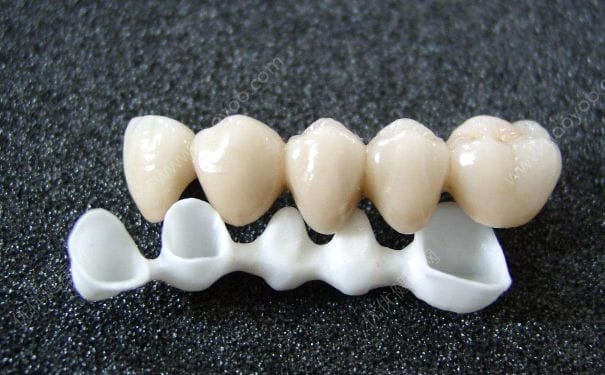 钴铬烤瓷牙能用多久？钴铬烤瓷牙优缺点有哪些？(1)
