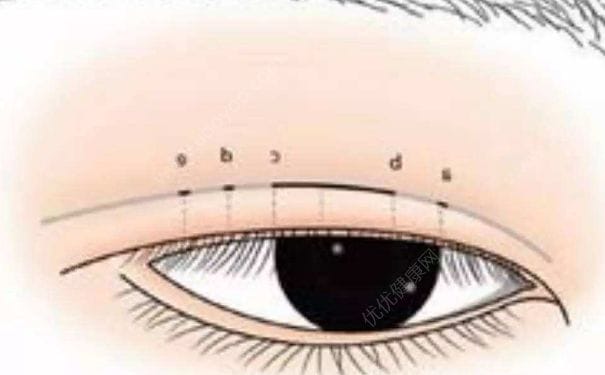 双眼皮修复多少钱？双眼皮修复成单眼皮可以吗？(1)