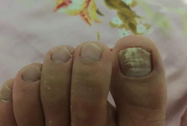 指甲变厚变黄是灰指甲吗 厚甲症与灰指甲有哪些区别