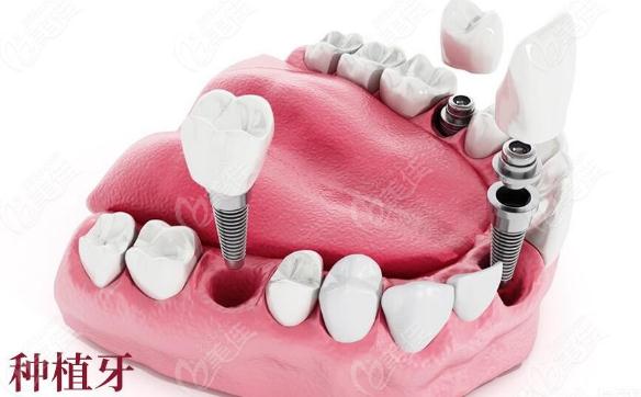 矫正牙齿的危害是什么 种植牙齿为什么只肿不痛呢