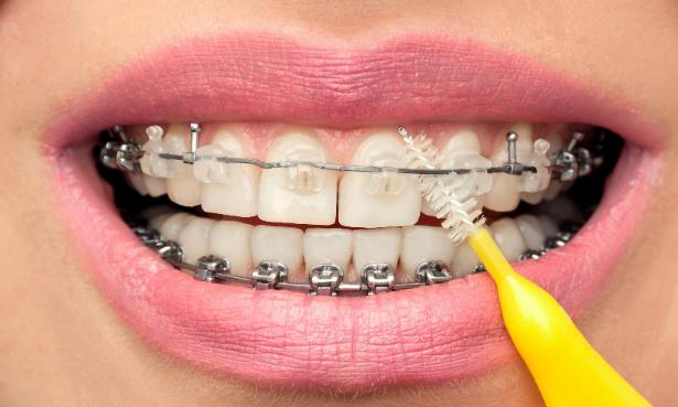 矫正牙齿的危害是什么 种植牙齿为什么只肿不痛呢