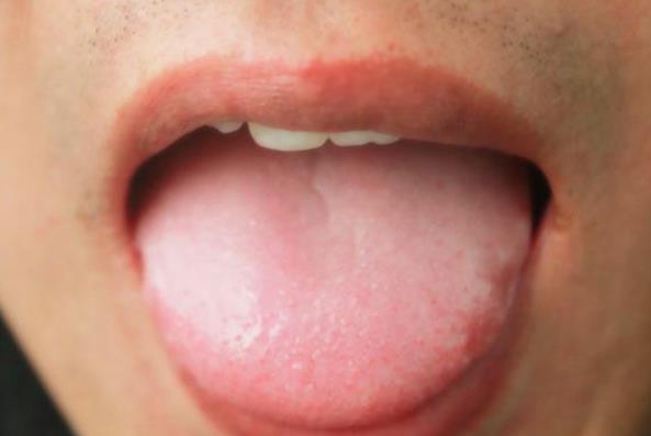 舌头发白是因为上火吗 多见于表热证或感受燥邪