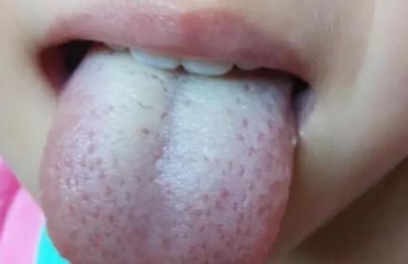 舌头发白是体内湿气重吗 舌头发白有哪些原因