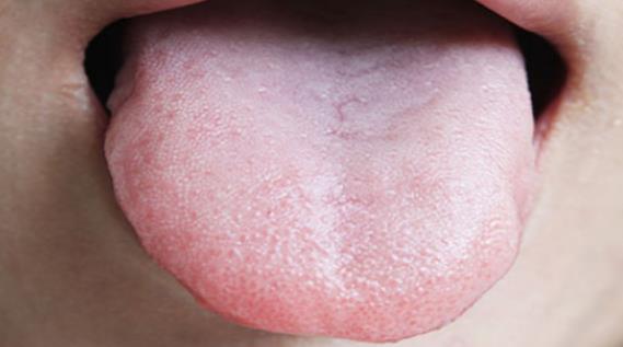 舌头发白是体内湿气重吗 舌头发白有哪些原因