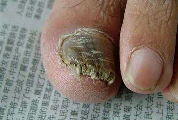 美甲会引起灰指甲吗 化学物质侵蚀指甲组织滋生细菌