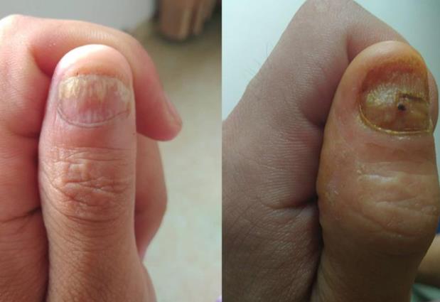 脚趾甲发白是灰指甲吗 白甲症与灰指甲有哪些区别