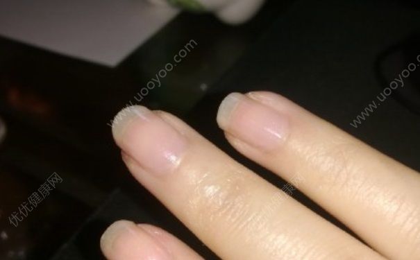 指甲上的竖纹代表什么？怎么去掉指甲上的竖纹？(5)