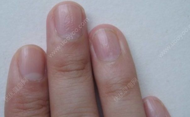 指甲上的竖纹代表什么？怎么去掉指甲上的竖纹？(2)
