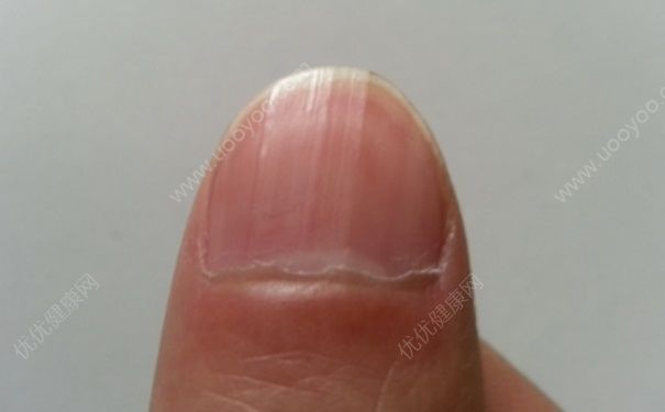 指甲上的竖纹代表什么？怎么去掉指甲上的竖纹？(1)