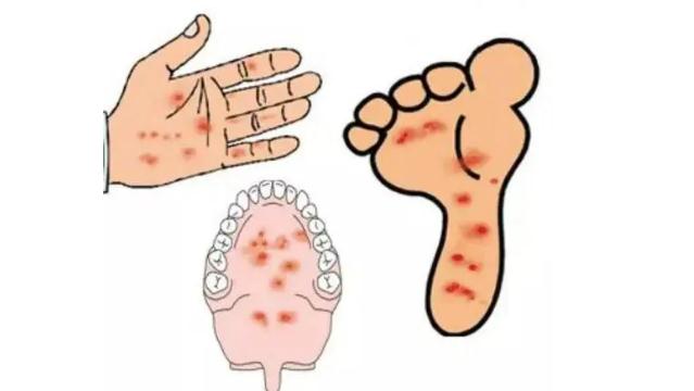 儿童手足口病皮疹需注意哪些 手足口病手上泡抓烂了怎么办